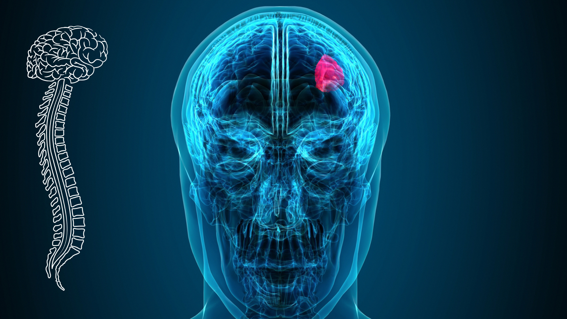 Glioma Cerebral: Qué es, Síntomas y Tratamientos en 2025